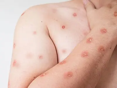 Brasil registra 81 casos de MPOX e Corumbá emite alerta preventivo