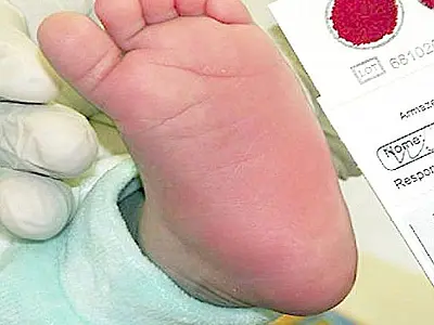 MS lança plano para ampliar diagnóstico e atendimento de Doença Falciforme