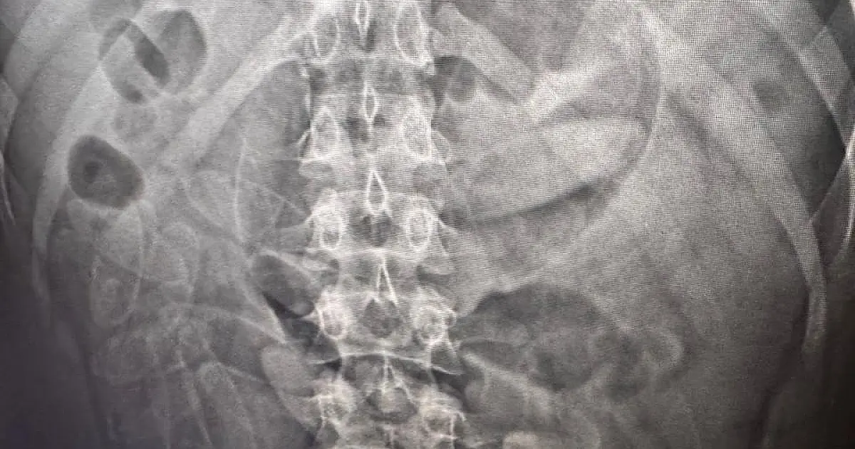 Seis bolivianos são presos traficando cápsulas de cocaína no corpo