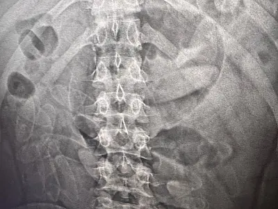 Seis bolivianos são presos traficando cápsulas de cocaína no corpo