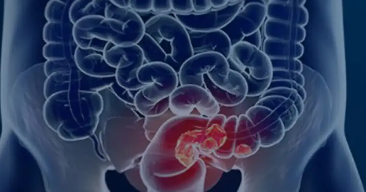 Estudo projeta aumento de 36% em mortes por câncer colorretal até 2040