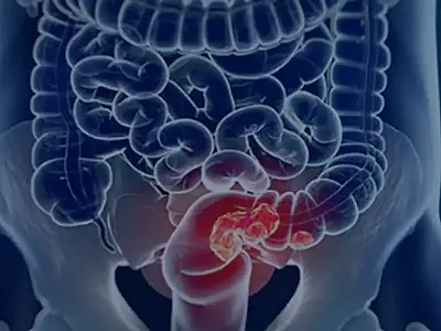 Estudo projeta aumento de 36% em mortes por câncer colorretal até 2040