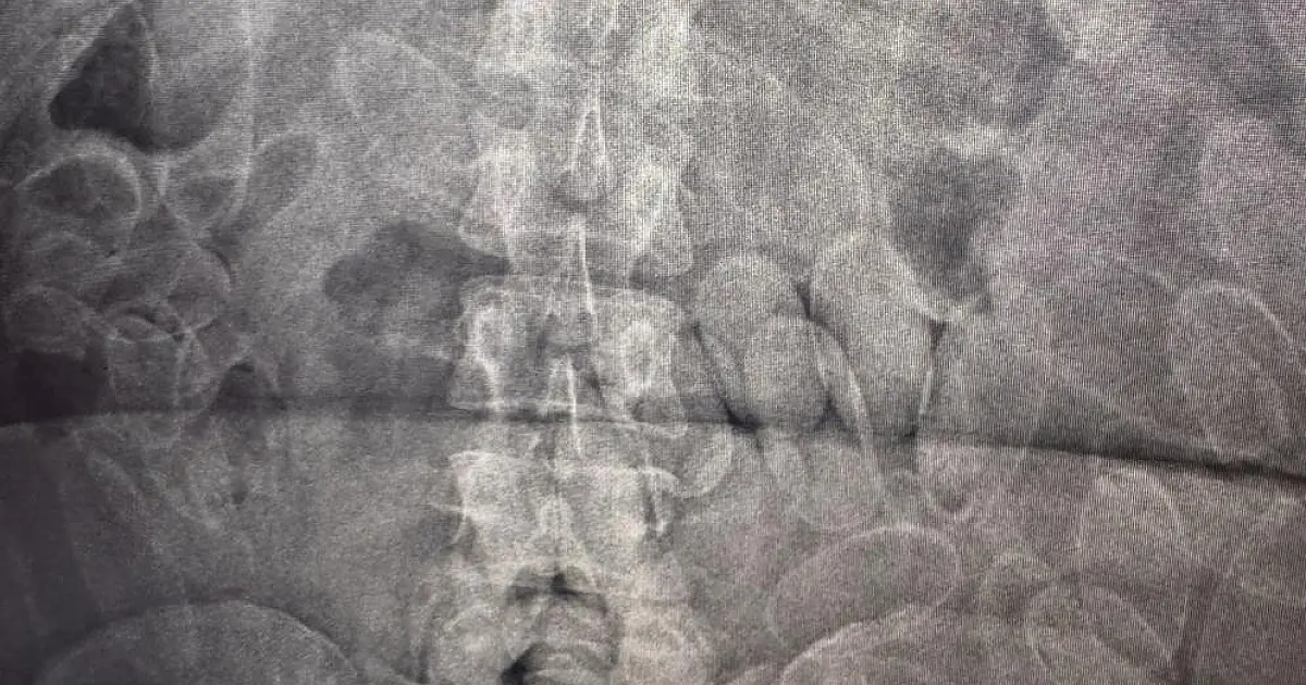 Exame detecta cápsulas de cocaína ingeridas por três bolivianos