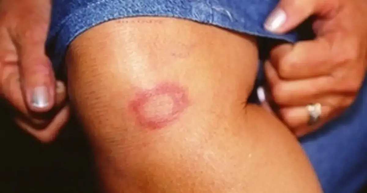 Casos de hanseníase são registrados quase todos os dias em MS