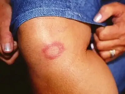 Casos de hanseníase são registrados quase todos os dias em MS