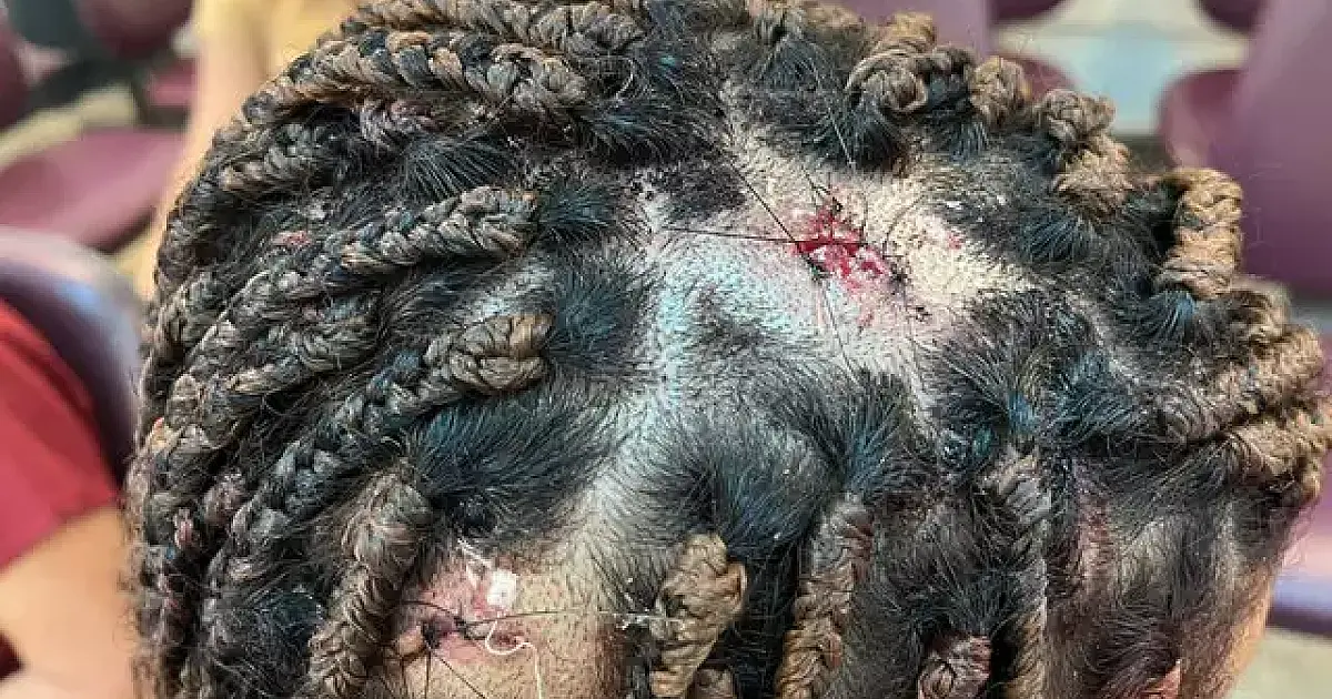 Jovem de 17 anos é agredida à marteladas pelo namorado ciumento