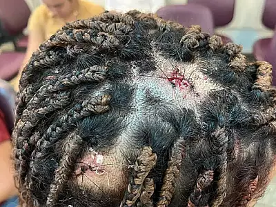 Jovem de 17 anos é agredida à marteladas pelo namorado ciumento