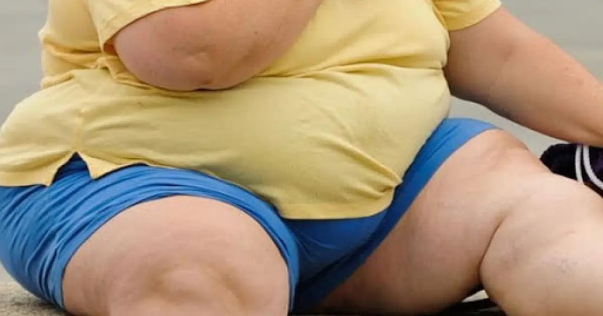 Projeto de Lei prevê implantação de Programa de Enfrentamento da Obesidade Mórbida na Saúde