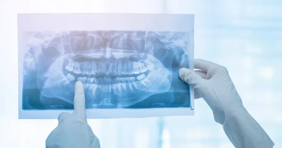 Corumbá recebe recurso federal para compra de raio-X odontológico panorâmico