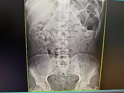 Boliviana é operada após sete dias para retirar 1kg cocaína do estômago