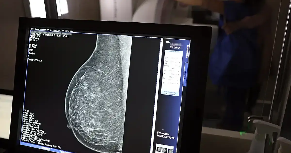 Ministério da Saúde passa a recomendar mamografia a partir dos 40 anos