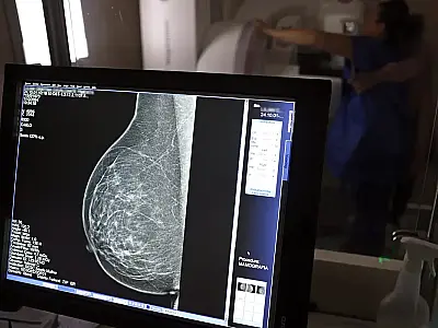 Ministério da Saúde passa a recomendar mamografia a partir dos 40 anos