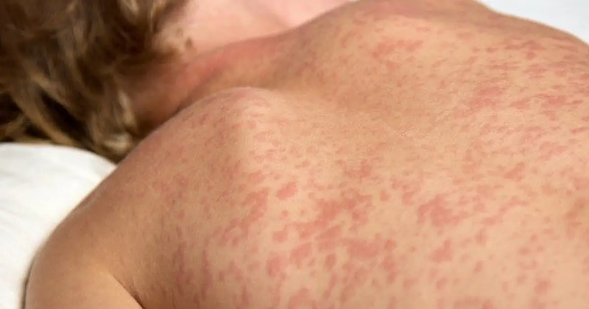 MS intensifica busca ativa por casos de sarampo e rubéola nos municípios