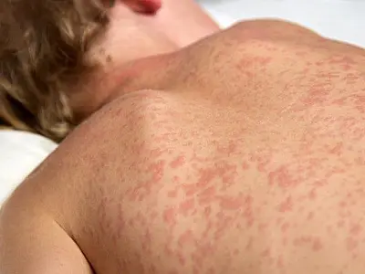 MS intensifica busca ativa por casos de sarampo e rubéola nos municípios