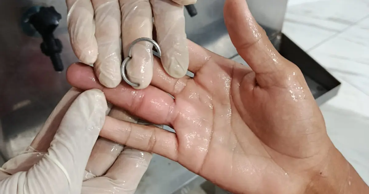 Bombeiros usam equipamento de precisão para retirar anel preso em dedo de adolescente