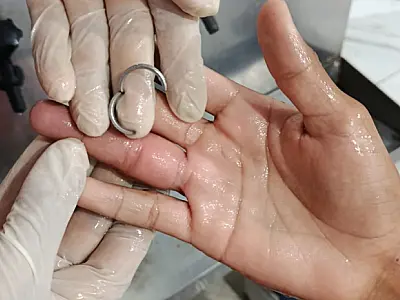 Bombeiros usam equipamento de precisão para retirar anel preso em dedo de adolescente