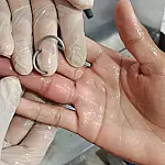 Bombeiros usam equipamento de precisão para retirar anel preso em dedo de adolescente